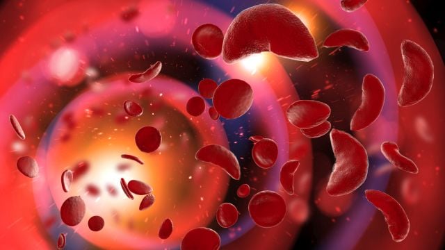 Alabama NewsCenter — New gene therapy could provide cure for sickle cell disease, according to UAB study