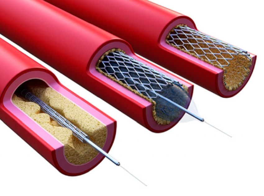Alabama NewsCenter — NIH grant to UAB will fund study of safer, more durable stents