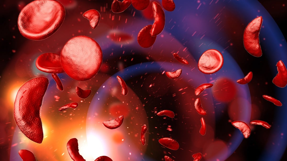 Alabama NewsCenter — Pfizer’s $5.4 billion deal could mean big things for sickle cell disease